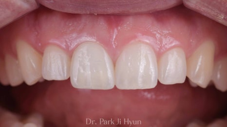 Improved anterior tooth shape and gum harmony after re-root canal treatment and aesthetic prosthetics