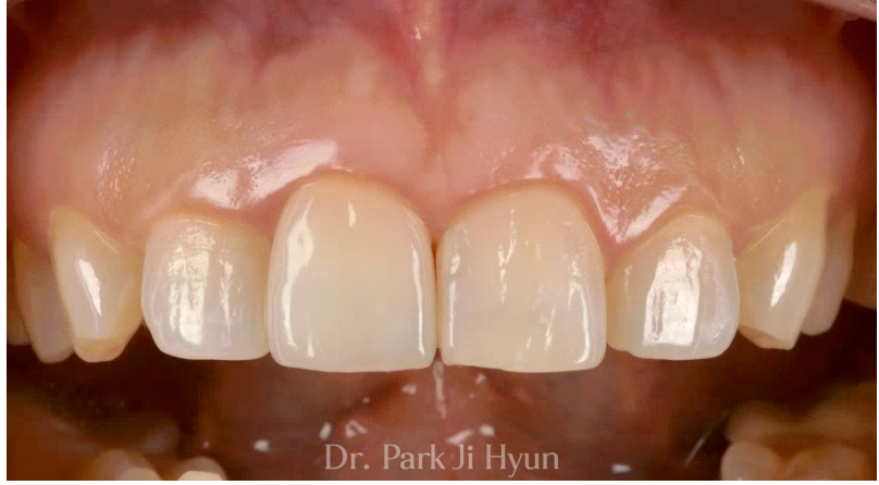 Maxillary anterior teeth with improved protrusion and gum asymmetry after BOPT re-prosthetic treatment