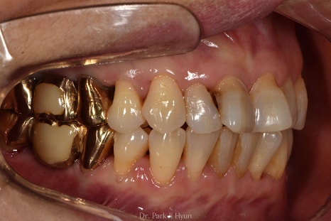 After precise occlusal analysis and prosthetic retreatment, multiple molars are now occluding in a balanced manner.