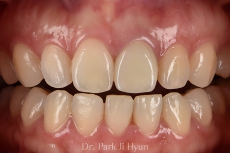 Improved color and visual symmetry with natural teeth after anterior crown retreatment.