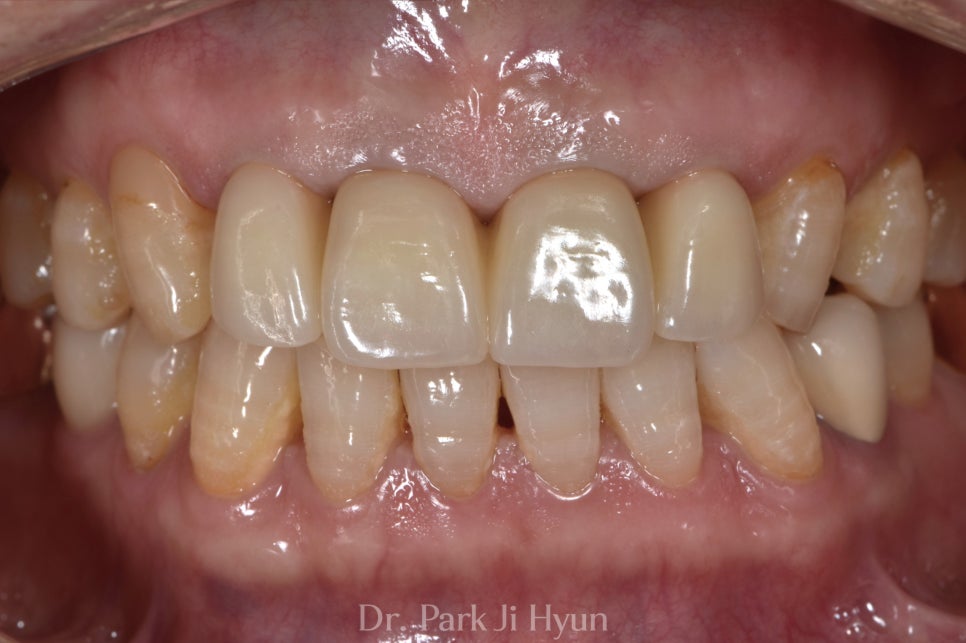 Improved gum swelling and discoloration of anterior teeth after retreatment with cleanable prosthetics.