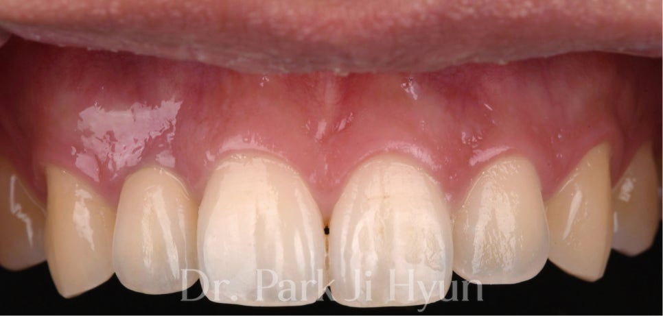 Anterior crowns matched in color and shape with surrounding natural teeth using Digital Try-in.