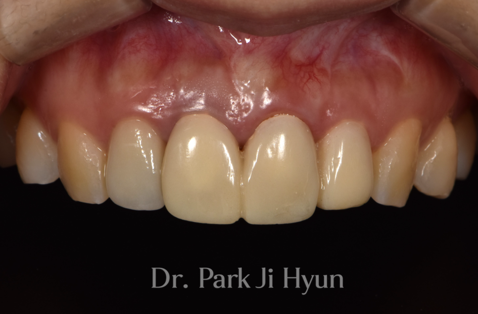 Improved front tooth alignment and gum line after gum contouring and crown retreatment without ankylosed tooth extraction