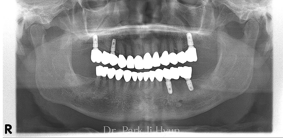 Improved tooth alignment and occlusion after implant placement and full-mouth crown restoration.