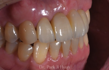 Restored anterior teeth and gum contours after guided implant placement, bone grafting, and aesthetic prosthetic treatment.