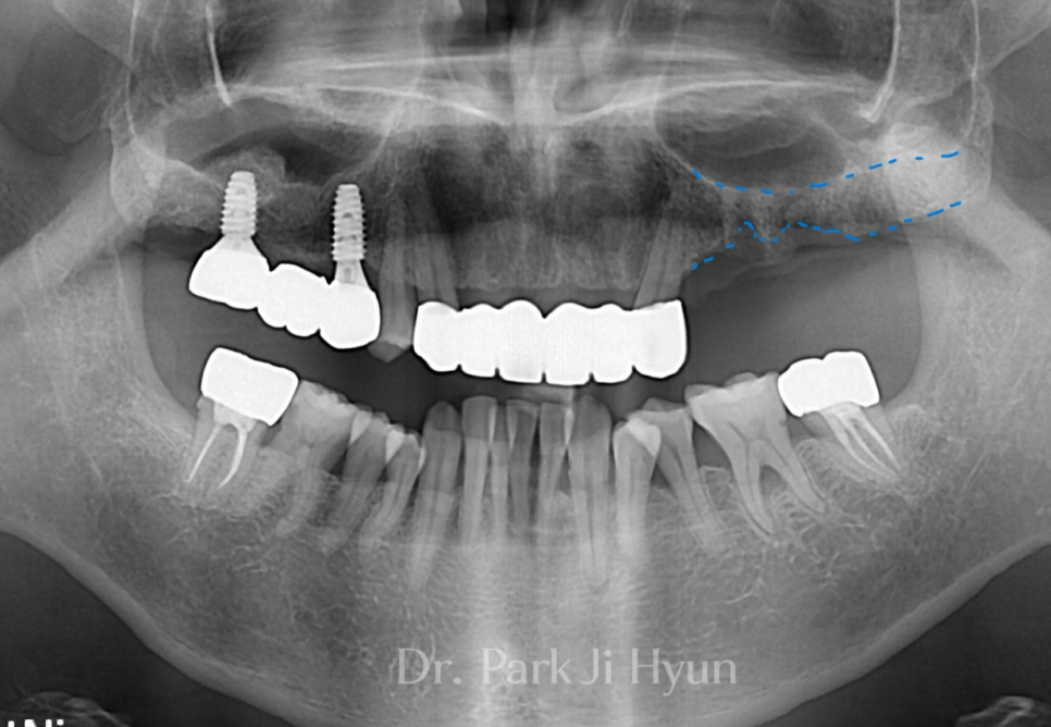 골이식 전 위턱 어금니 부위의 얇은 잔존골이 표시된 파노라마 방사선 사진