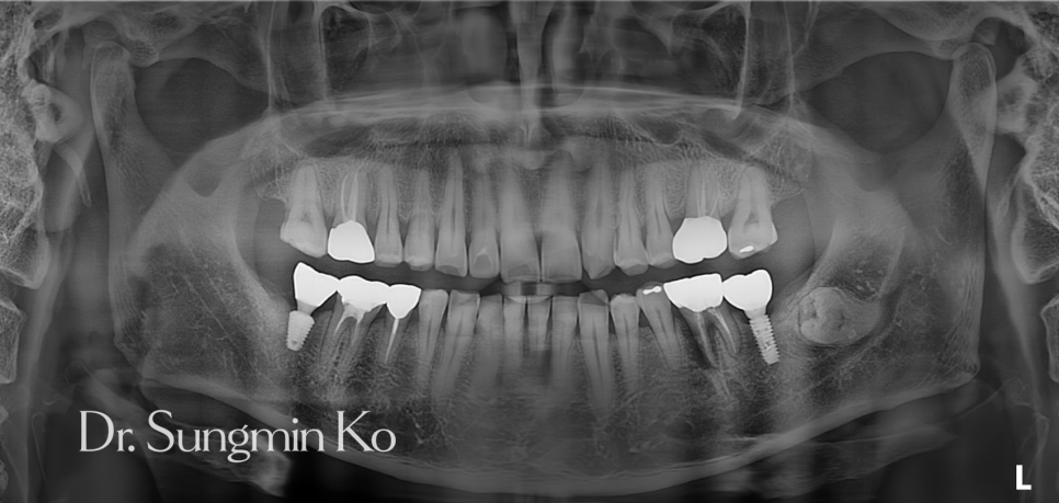 신경치료한 아래 어금니 앞쪽 뿌리 주변의 광범위한 염증과 골소실이 보이는 치료 전 CT