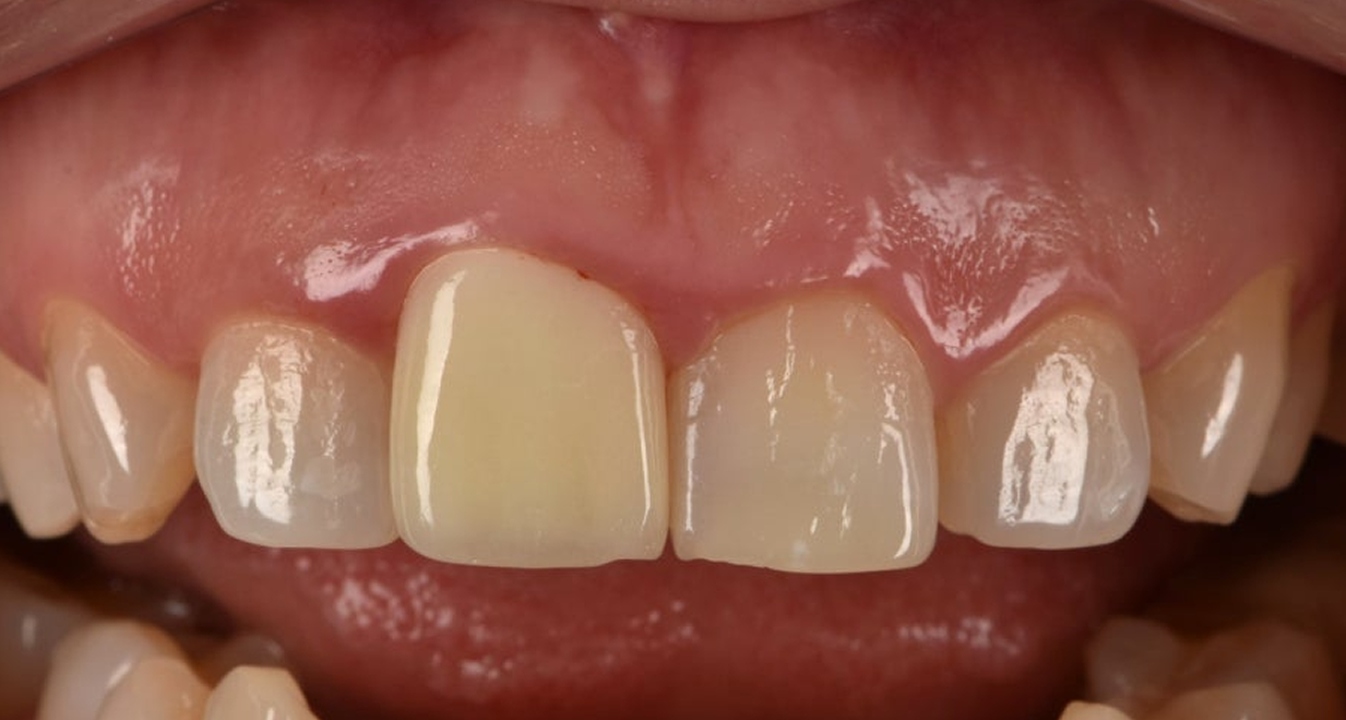 Before Treatment Photo