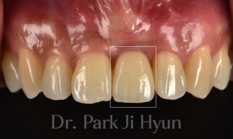 Improved anterior tooth length and gum line after gum grafting and implant re-prosthetic treatment