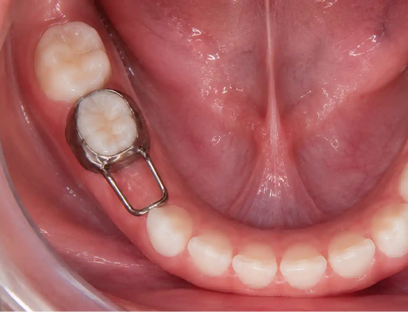 What a growing child needs is not the fastest possible orthodontics, but the right type of orthodontics started at the appropriate time.