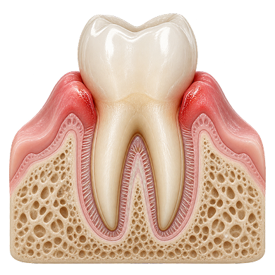 Cross-section of a tooth with inflamed, swollen gums