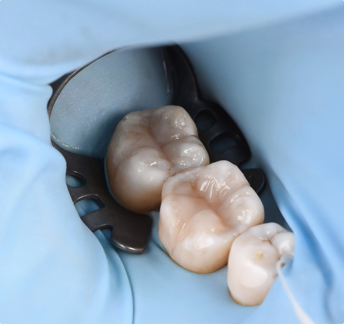Resin Buildup