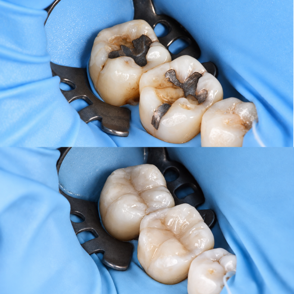 Replacement of old metal restorations