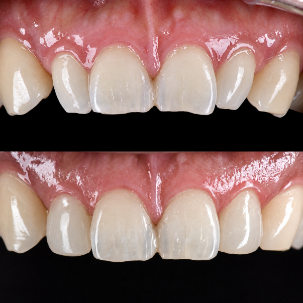 Improvement of front tooth shape and proportion