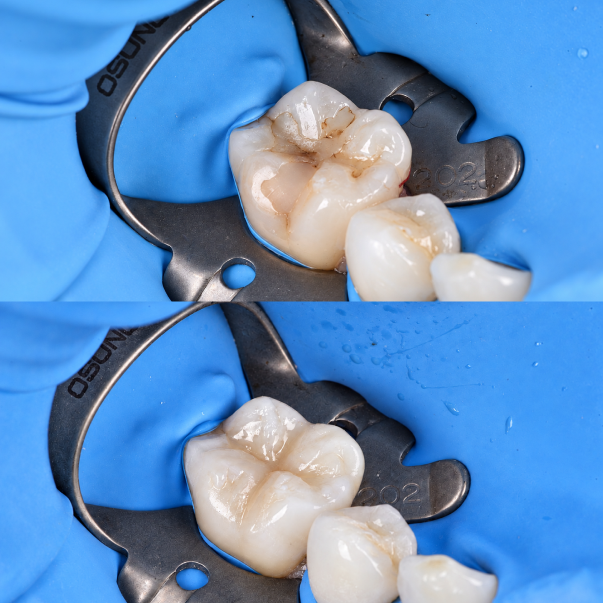 Restoration of fractured molar areas