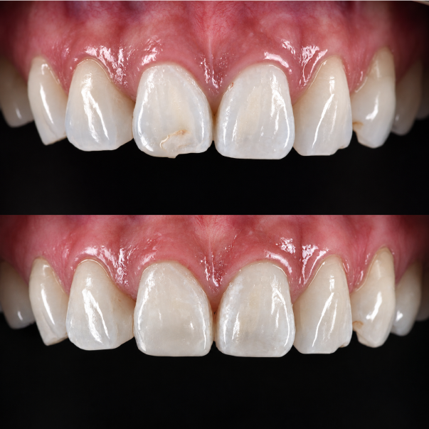 Restoration of minor front tooth fractures