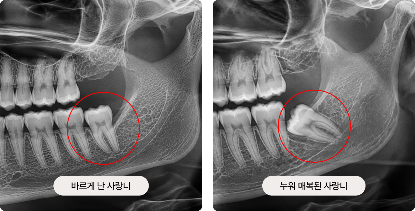 Wisdom Tooth Extraction